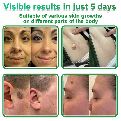 80%📌Hudros® 2-in-1 Microneedle & Hydrocolloid Patch | Raised Moles,Acne,  Flat Warts & Skin Tags Remover | Improves Wrinkles, Scars & Blemishes | Invisible Star Pimple Patches for Face & Body | 144 Count