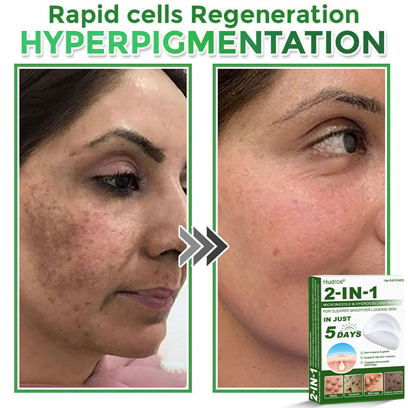 80%📌Hudros® 2-in-1 Microneedle & Hydrocolloid Patch | Raised Moles,Acne,  Flat Warts & Skin Tags Remover | Improves Wrinkles, Scars & Blemishes | Invisible Star Pimple Patches for Face & Body | 144 Count